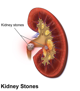 Blausen_0595_KidneyStones