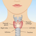 hyothyroidism